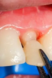 Resin ( acrylate ) crown for temporary crown treatment, that are used in cases when the patien has to walk away with buffed teeth from the dentist. These have protective role on teeth,  with less regard on aestetics.